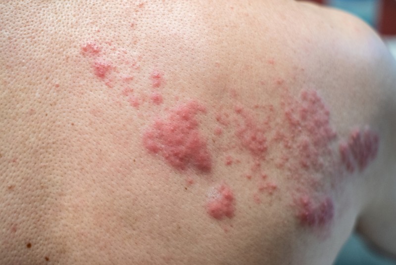 Kleine Rote Punkte Unter Der Haut Petechien Symptome Stecknadelgrosse Punkte Auf Der Haut 02 16