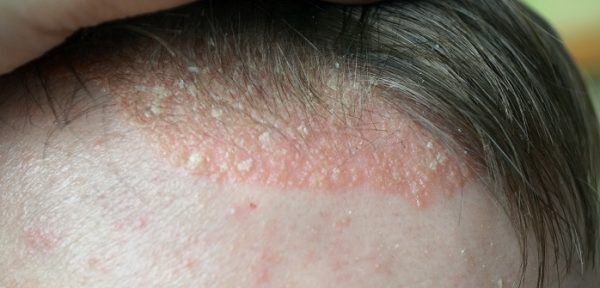 Neurodermitis Auf Der Kopfhaut Bilder