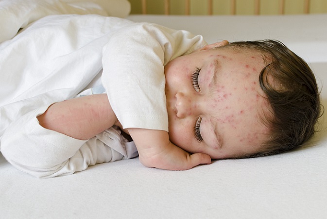 Da das Immunsystem von Kindern noch nicht so ausgereift ist wie das von Erwachsenen, sind sie viel anfälliger für alle Arten von Infektionen. Da viele Kinderkrankheiten mit einem Hautausschlag einhergehen, kann es für Eltern mitunter schwierig werden, die genaue Ursache zu identifizieren. (#01)