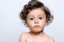 Hautausschlag bei Kindern: Welche Krankheit steckt dahinter? (Foto: AdobeStock - 169526171 luanateutzi)