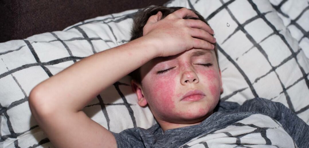 Hautausschlag im Gesicht: Ursache, Symptome & Hausmittel (Foto: AdobeStock - _474559970 Наталья Вагнер)