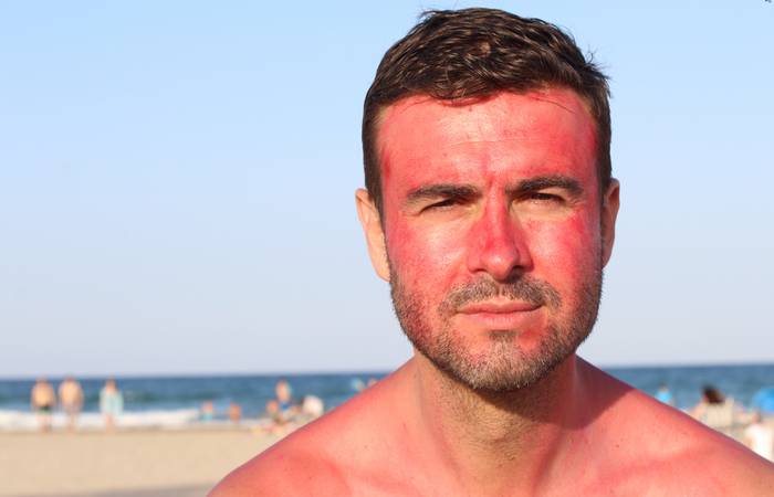 Starke Sonneneinstrahlung kann ein Auslöser für Hautausschläge im Gesicht sein, insbesondere in heißen Klimazonen oder während der Sommermonate. (Foto: AdobeStock - 210651753 ajr_image( s )