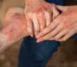 Hautausschlag durch Allergie: Tipps gegen Quaddeln, Pusteln & rote Flecken (Foto: AdobeStock - 494115733 InfiniteStudio)