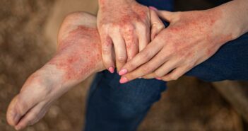 Hautausschlag durch Allergie: Tipps gegen Quaddeln, Pusteln & rote Flecken (Foto: AdobeStock - 494115733 InfiniteStudio)