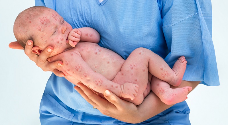 Oftmals tritt der Hautausschlag beim Baby als Folge einer der typischen Kinderkrankheiten auf. Ein bekanntes Beispiel hierfür sind die Windpocken.
