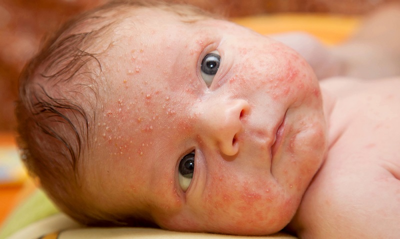 Die unterschiedlichen Ausprägungen des Hautausschlags beim Baby weisen bereits darauf hin, dass diesem Phänomen ganz unterschiedliche Ursachen zugrunde liegen können.