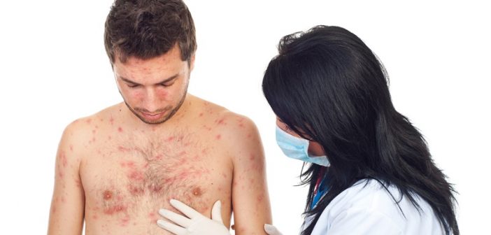 Wenn der Arzt vermutet, dass eine Allergie die Beschwerden auslöst, dann veranlasst er normalerweise die Durchführung eines Allergietests. 