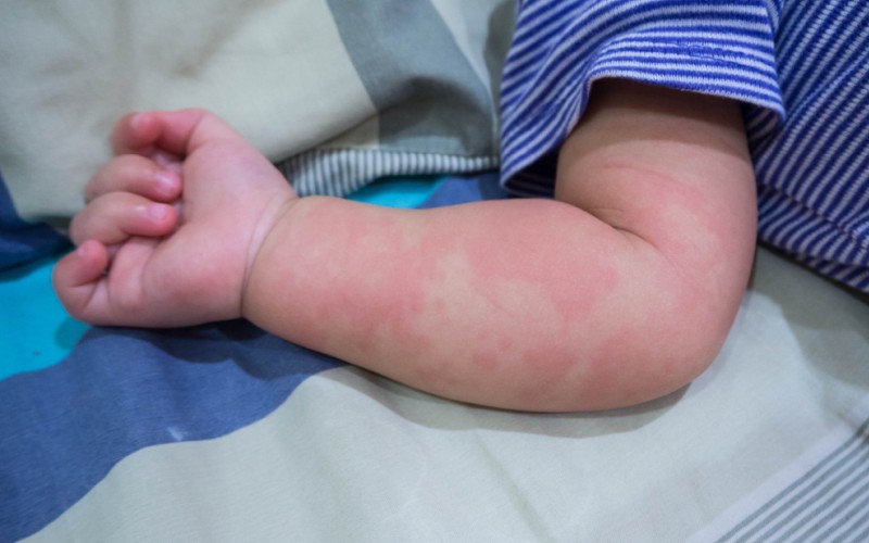 Die Nesselsucht oder auch Urtikaria kann unterschiedlich aussehen. Roter flächiger Ausschlag über ganze Teile des Körpers hinweg, wie auf diesem Baby Arm zu sehen. (#3)