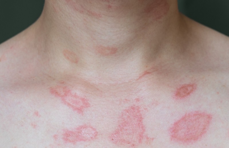 Die roten Punkte auf der Haut unterscheiden sich nicht nur in Göße und Aussehen, sondern darüber hinaus auch in Ursache und Behandlungsmöglichkeiten. Das Foto zeigt rote fleckige Punkte auf dem Oberkörper, in diesem Fall ist die Diagnose eine Dermatitis. (#2)