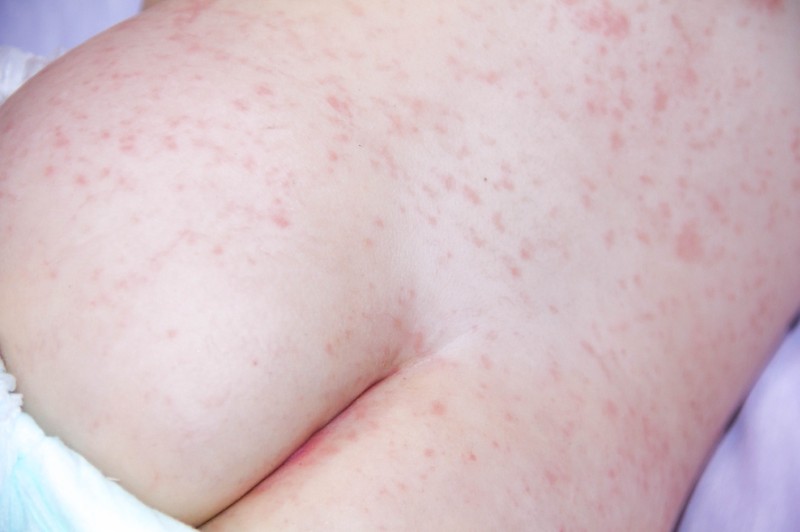 Allergien als Auslöser für rote Punkte auf der Haut.