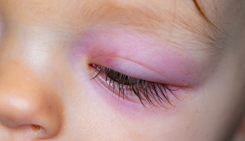 Körperliche Symptome einer Neurodermitis: geschwollene Augenlider