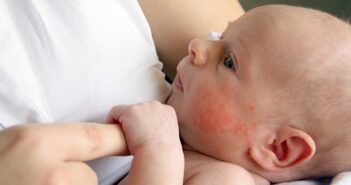 Neurodermitis beim Kind: Ursachen, Symptome & Behandlung Neurodermitis beim Kind: Ursachen, Symptome & Behandlung