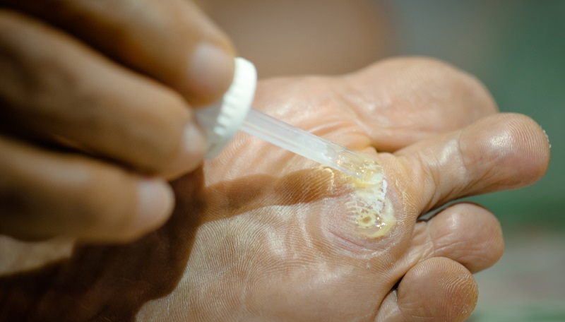 Hautwucherungen, die besonders für Unsicherheit sorgen, sind Warzen. ( Foto: Shutterstock- SURKED )