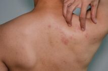 Histamin Allergie: Was bedeutet Histamin Unverträglichkeit? (Foto: AdobeStock - 427455190 sakaj)