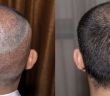 Türkei etabliert sich als führendes Ziel für Haartransplantationen (Foto: AdobeStock - Sugrit - 290465761)