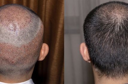 Türkei etabliert sich als führendes Ziel für Haartransplantationen (Foto: AdobeStock - Sugrit - 290465761)