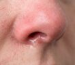 Trockene Nasenschleimhaut? Das sind die Ursachen und diese Tipps helfen (Foto: AdobeStock - nightowl studio - 2197310702)